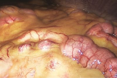 A graphic medical image of visceral fat